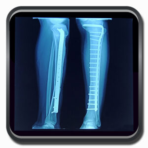 centro de ortopedia e fisioterapia Batel - Cofib - Cirurgias Complexas Sistema Locomotor