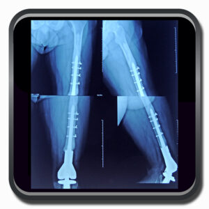 centro de ortopedia e fisioterapia Batel - Cofib - Cirurgias Complexas Sistema Locomotor