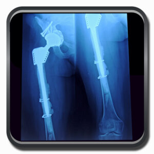 centro de ortopedia e fisioterapia Batel - Cofib - Cirurgias Complexas Sistema Locomotor