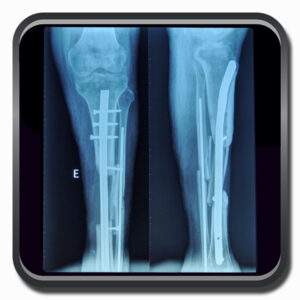 centro de ortopedia e fisioterapia Batel - Cofib - Cirurgias Complexas Sistema Locomotor