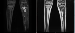 Clinica COFIB - Sarcoma de Extremidades