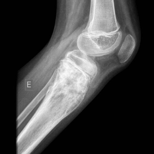 Diagnóstico O diagnóstico precoce dos sarcomas de extremidades é fundamental para melhorar o prognóstico. O processo diagnóstico geralmente inclui: 1. Exame Físico: Avaliação clínica da área afetada, onde o médico pode identificar a presença de um nódulo ou crescimento anormal. 2. Exames de Imagem: • Radiografias (Raio-X): Útil para detectar alterações nos ossos, como no osteossarcoma. • Ressonância Magnética (RM): Fornece detalhes sobre a extensão do tumor e sua relação com os tecidos moles ao redor. • Tomografia Computadorizada (TC): Ajuda a avaliar a extensão do tumor, especialmente nos ossos. • Tomografia por Emissão de Positrões (PET): Pode ser usada para detectar metástases. 3. Biópsia: Essencial para confirmar o diagnóstico. Uma amostra de tecido é removida e analisada em laboratório para determinar o tipo de sarcoma.
