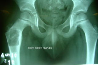 Clínica Cofib CISTO ÓSSEO SIMPLES