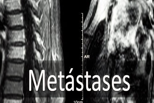 Metástases