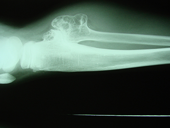 Clinica Cofib OSTEOCONDRMA FIBULA