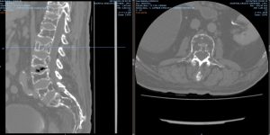 Clinica Cofib: Mieloma Multiplo