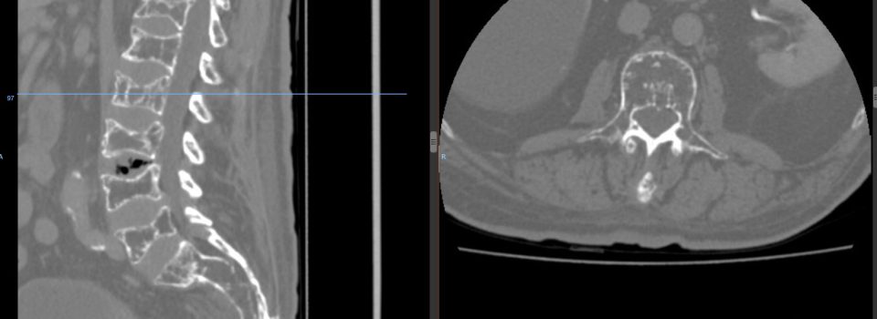 Clinica Cofib: Mieloma Multiplo