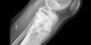Clinica Cofib: Sarcoma Ósseo