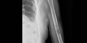 Clinica Cofib: Tumores Osseos