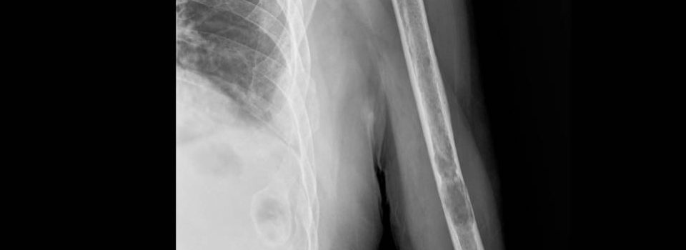 Clinica Cofib: Tumores Osseos